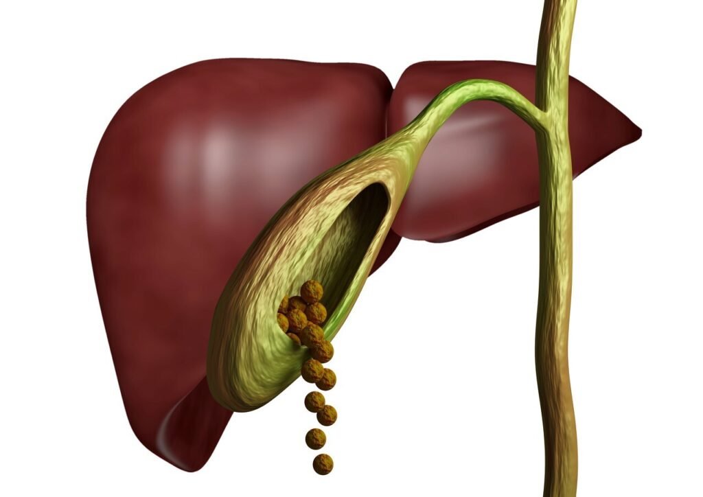 Gallbladder stones